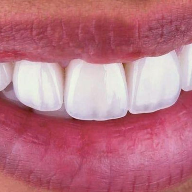 Resultado de diseño de sonrisa — caso 1