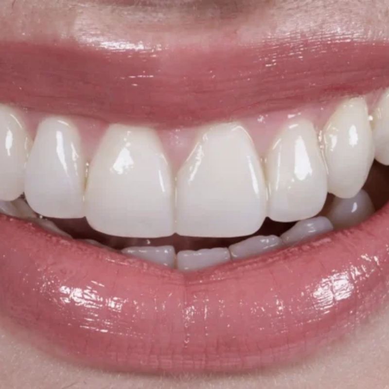 Resultado de diseño de sonrisa — caso 2