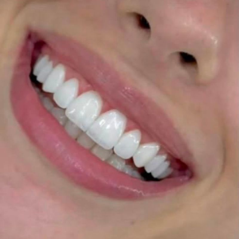 Resultado de diseño de sonrisa — caso 3