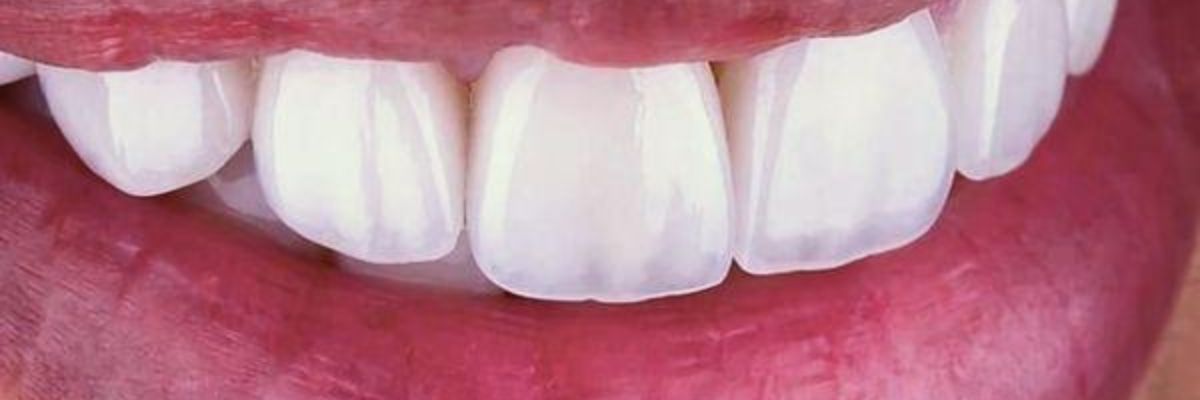 Ceramic veneers