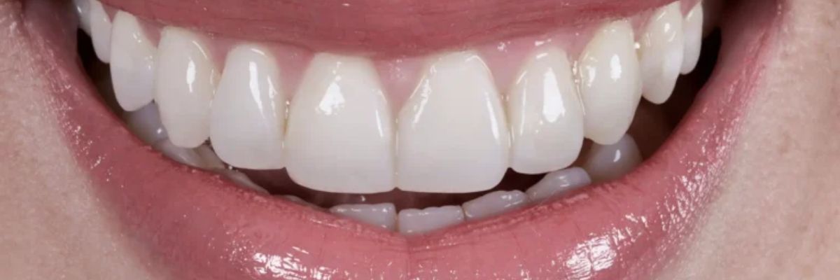 Resin veneers