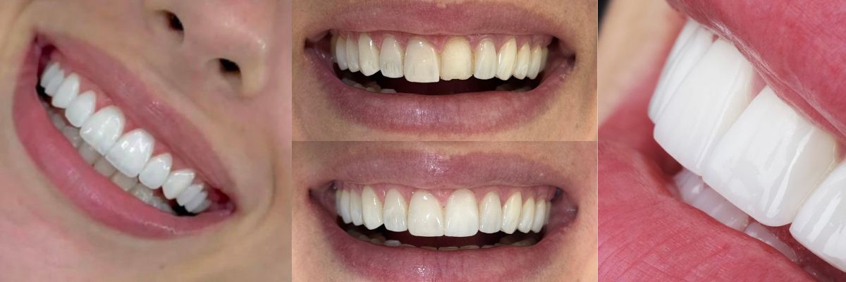 Smile design result at OV Dental Studio