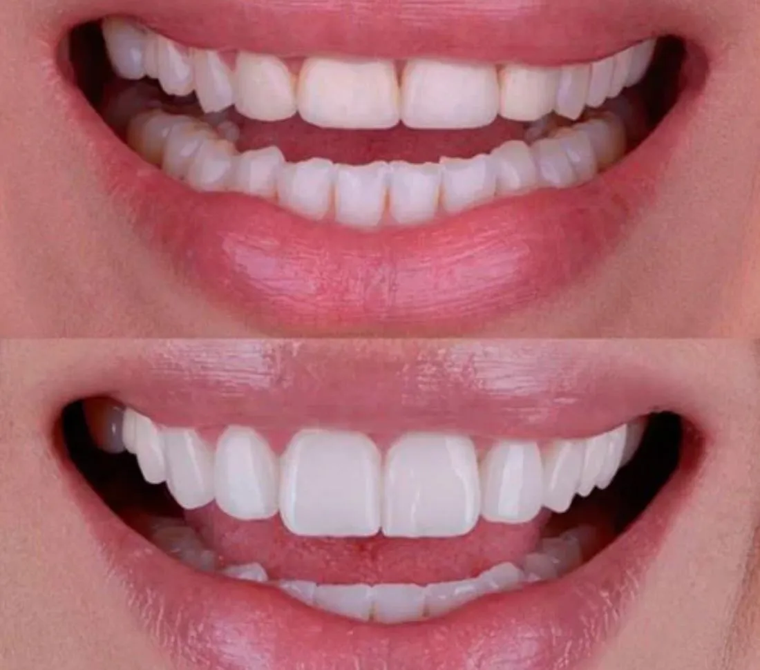 Diseño de Sonrisa en OV Dental Studio