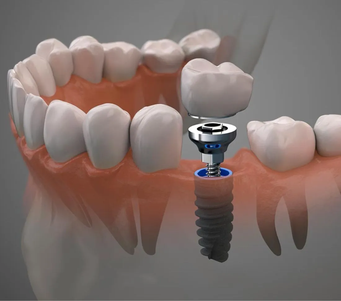 Implantes Dentales en OV Dental Studio