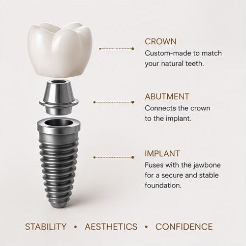 Dental implant parts: crown, abutment and implant