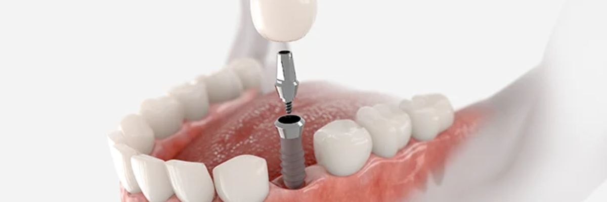Top-tier dental implant materials
