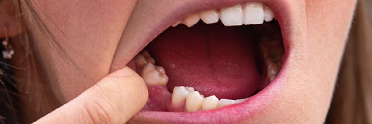 Patient at a dental implant consultation at OV Dental Studio